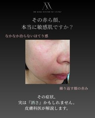その赤ら顔、本当に敏感肌ですか？